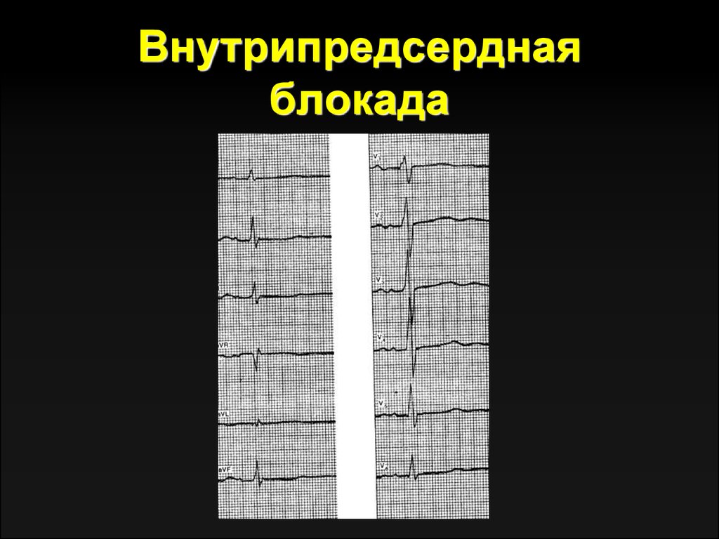 Внутрипредсердная проводимость. Внутрипредсердная блокада на ЭКГ. Внутрипредсердная блокада 2 степени на ЭКГ. Межпредсердная блокада 3 степени ЭКГ. ЭКГ при внутрипредсердной блокаде ЭКГ.