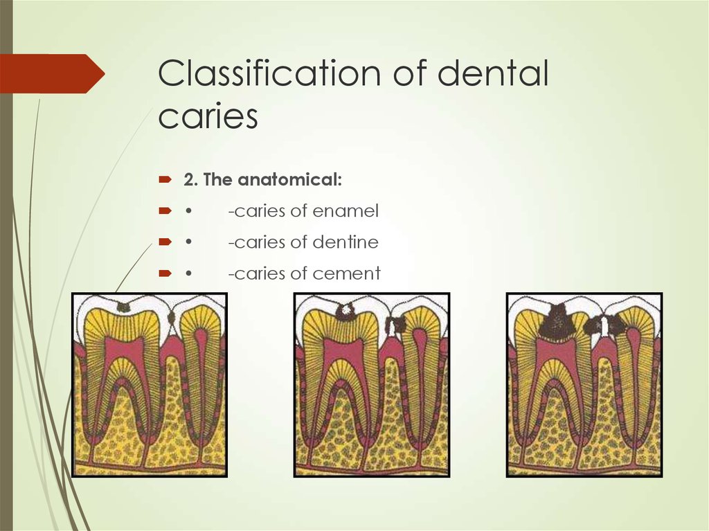 Dental caries and pulpitis - презентация онлайн