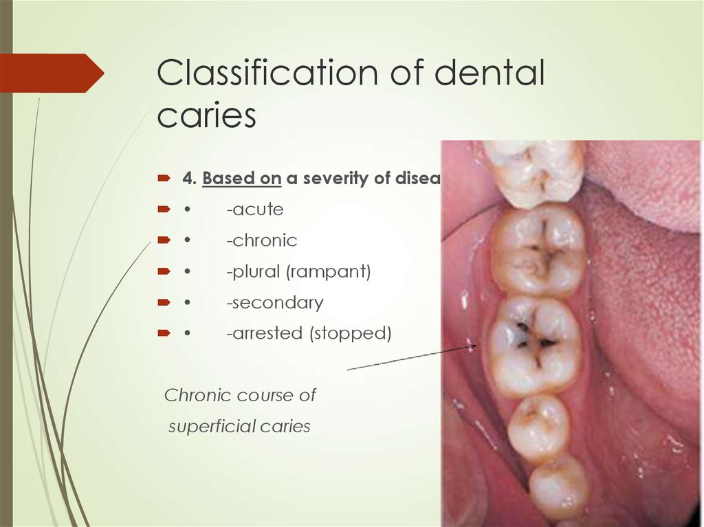 Dental Caries And Pulpitis 