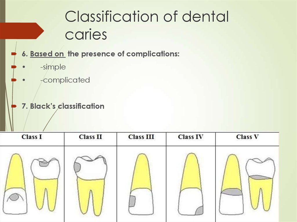 Dental Caries Gv Black Classification Of Carious Lesions | My XXX Hot Girl