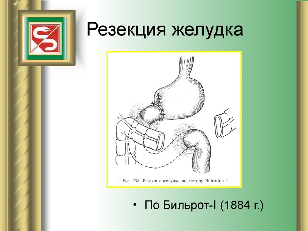 Резекция желудка. Операция по Бильрот 1 и 2 схема. Гастроэнтероанастомоз по Бильрот 2. Бильрот 2 с брауновским соустьем. Дистальная субтотальная резекция желудка по Бильрот 1.