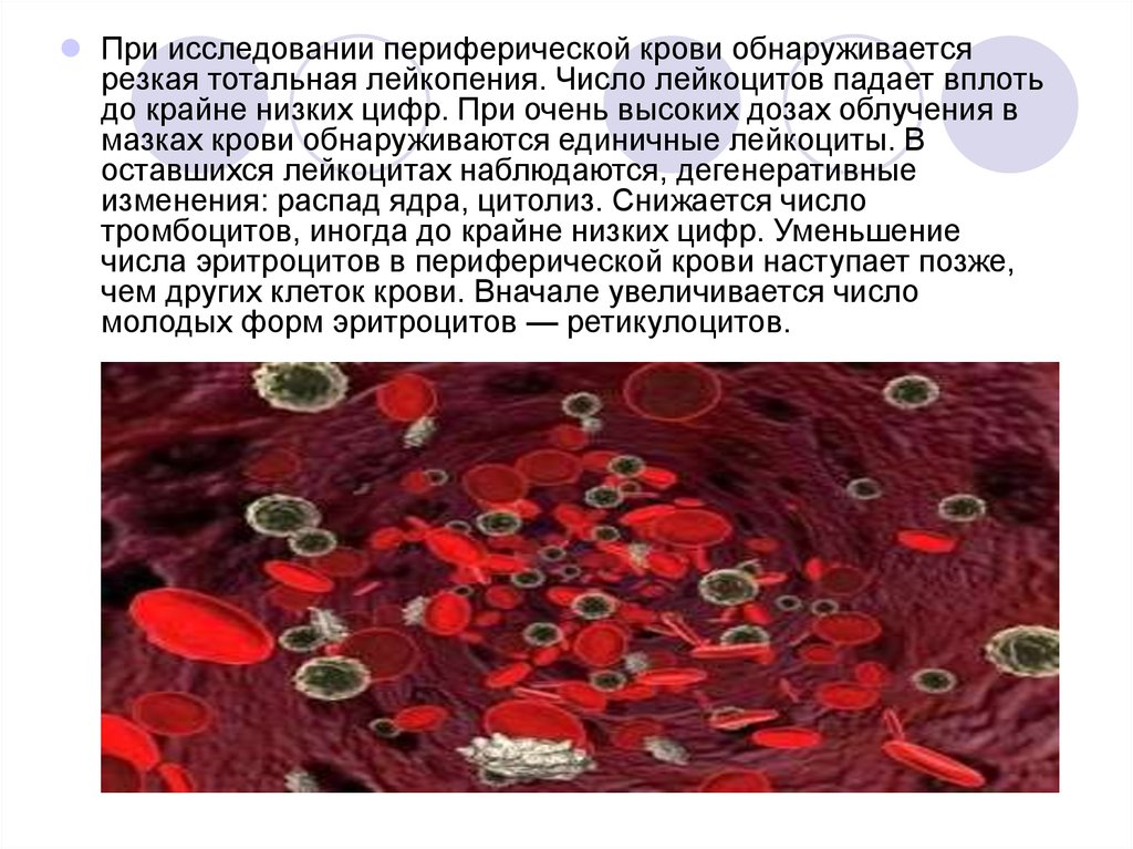 Изменение клеток крови. Изменения лейкоцитов при лучевой болезни. Кровь при лучевой болезни. Клетки периферической крови. Лейкоциты периферия крови.