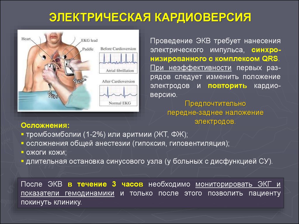 После кардиоверсии