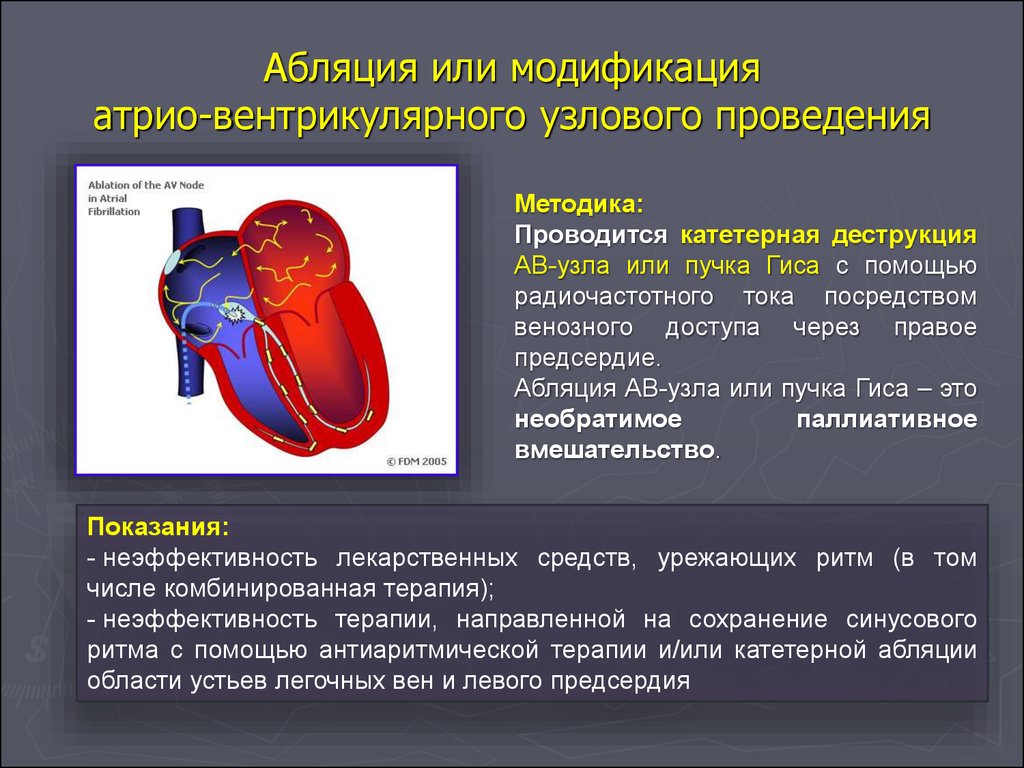 Сколько вен в левом предсердии. Абляция атриовентрикулярного узла. Радиочастотная аблация аритмий сердца. Радиочастотная катетерная абляция. Радио чястотная облация сердца.