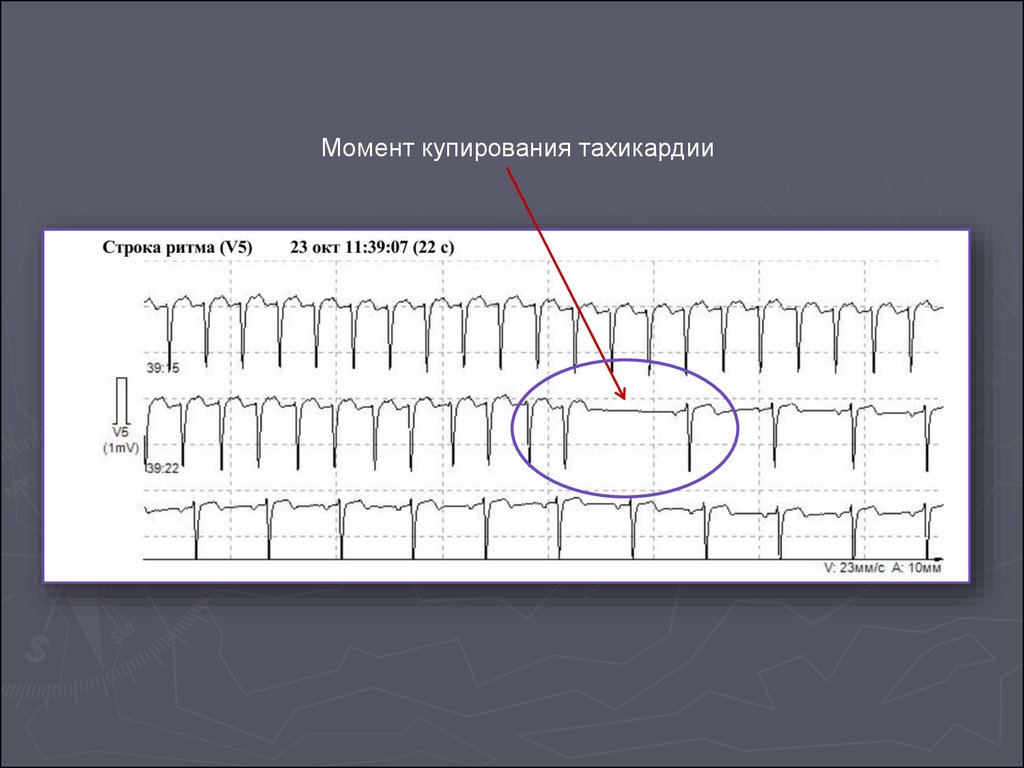 Купирования нарушение ритма. Рефлекторное купирование нарушений ритма. Arrhythmology.