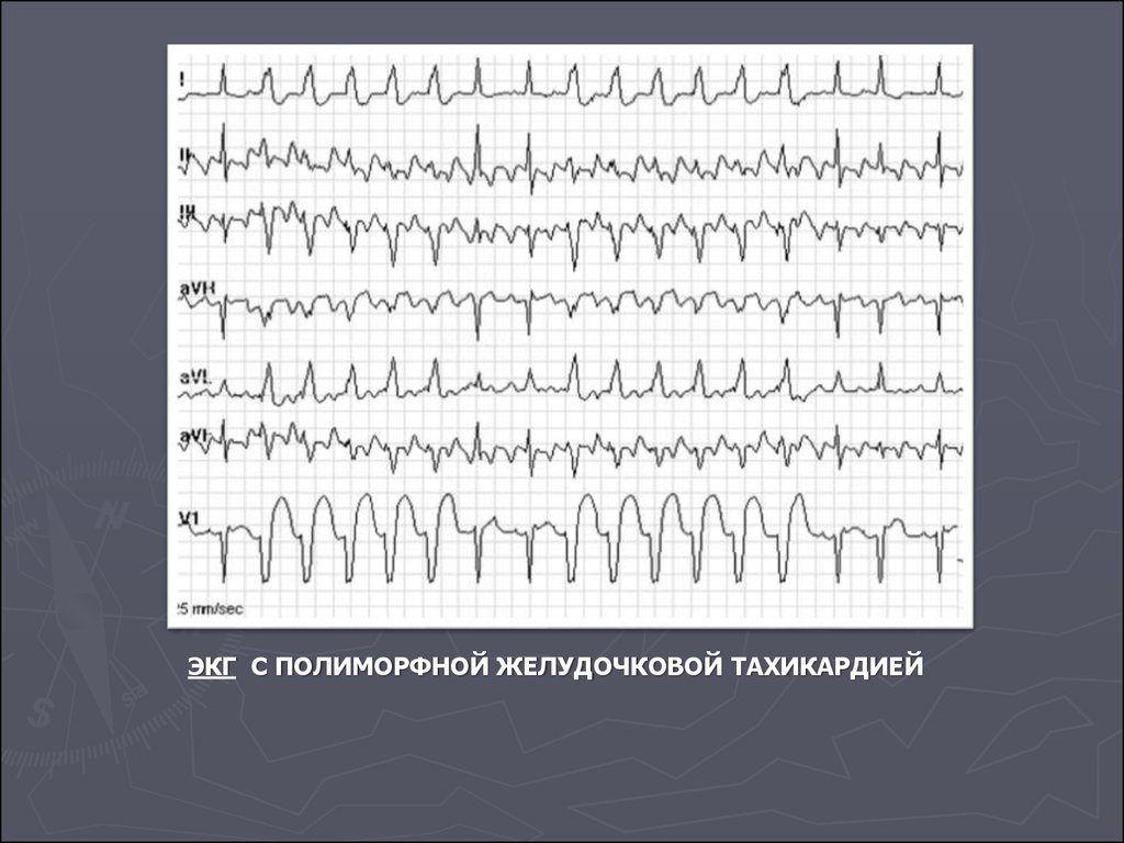 Желудочковая тахикардия экг фото