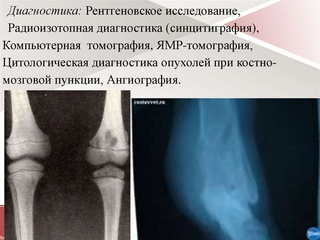 Диагностика опухоли кости. Доброкачественные опухоли опорно-двигательного аппарата. Классификация опухолей опорно-двигательного аппарата.. Доброкачественные опухоли опорно двигательной системы. Опухоли костей классификация.