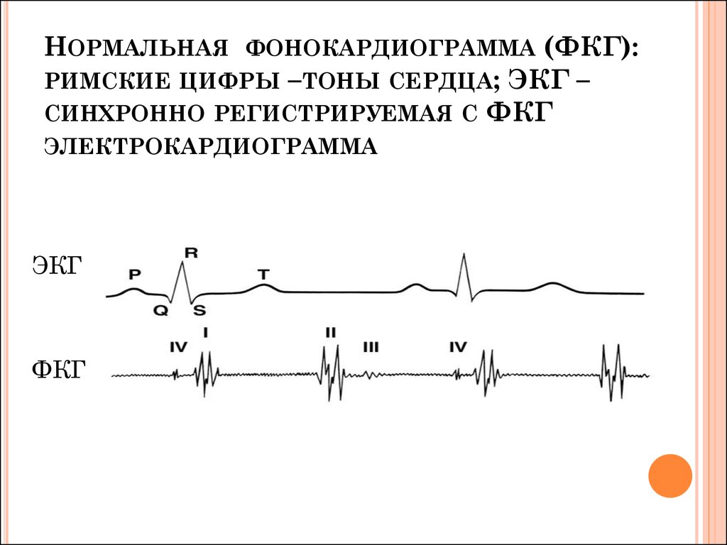 Нормальная фонокардиограмма (ФКГ): римские цифры –тоны сердца; ЭКГ – синхронно регистрируемая с ФКГ электрокардиограмма
