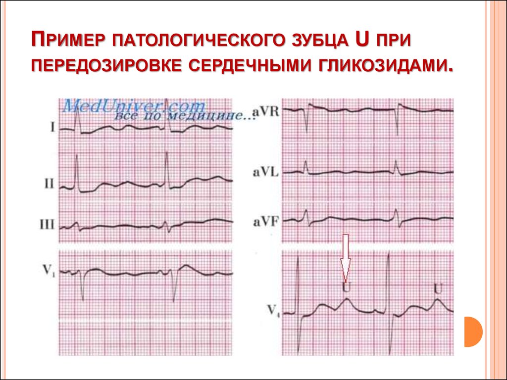 Синусовый ритм у взрослого. Электрокардиограмма показатели синусовый ритм. Зубец u на ЭКГ. Норма ЭКГ синусный ритм. ЭКГ нормальные синусовый ритм норма.