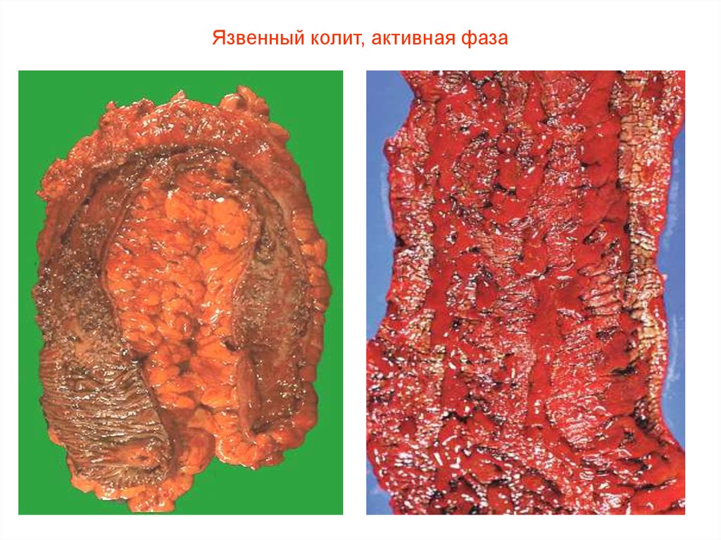 Язвенный колит, активная фаза