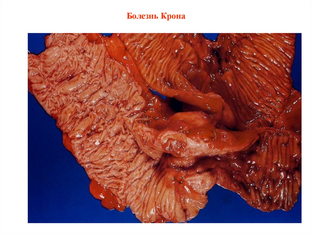 Болезнь Крона
