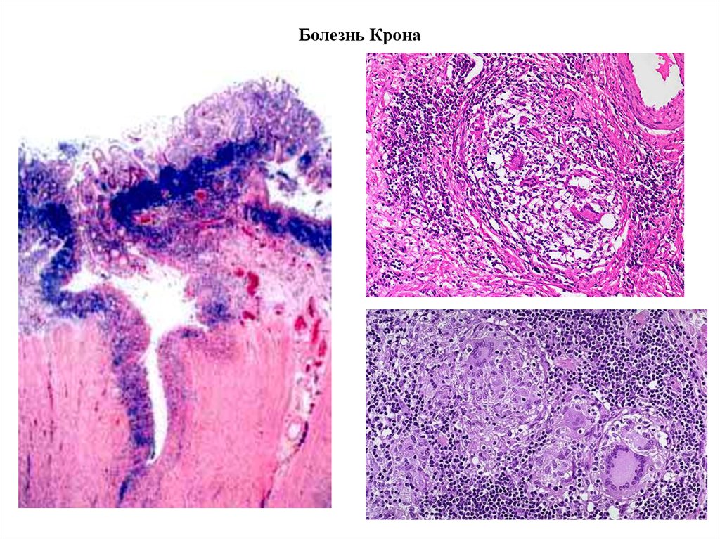 Болезнь крона гистологическая картина