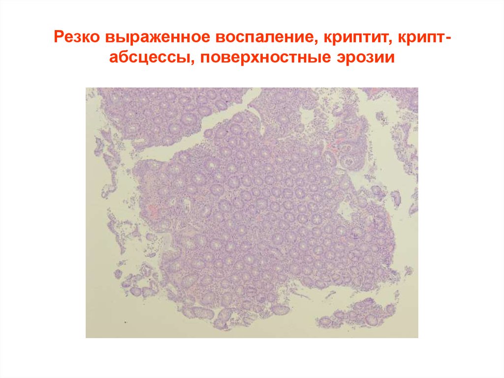 Резко выраженный. Крипт абсцессы кишечника это что. Крипт абсцессы кишечника при няк. Крипт абсцесс микропрепарат.