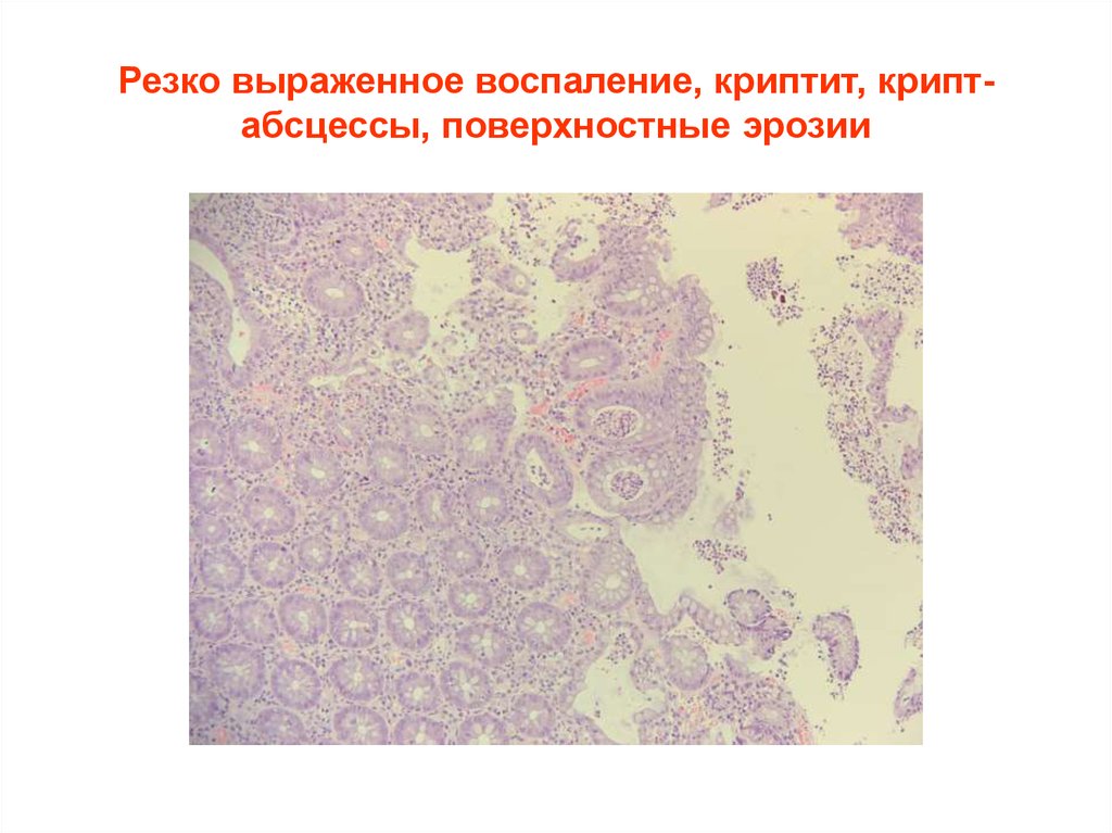 Резко выраженный. Крипт абсцессы кишечника это что. Крипт-абсцесс язвенный.