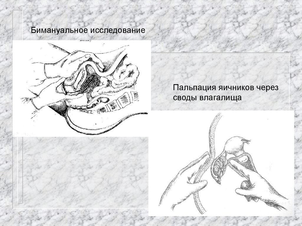 Влагалищное исследование. Техника бимануального исследования гинекологических больных. Бимануальное исследование женщин техника. Бимануальное влагалищное исследование норма. Бимануальное исследование органов малого таза;.