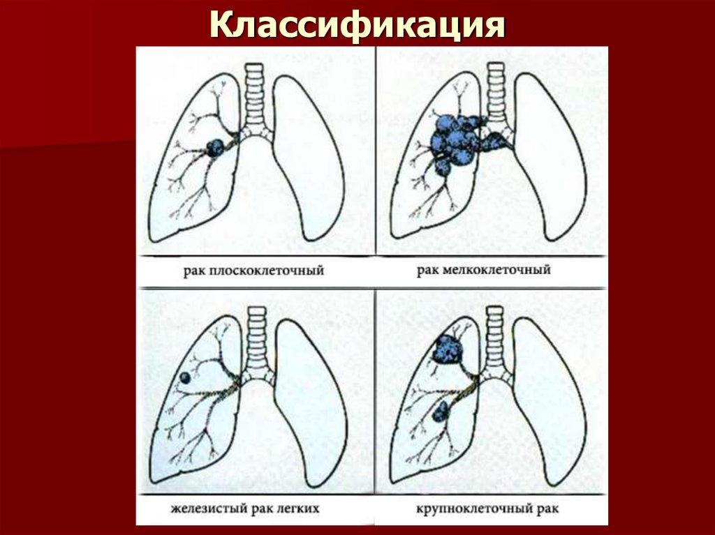 Рак легкого рисунок