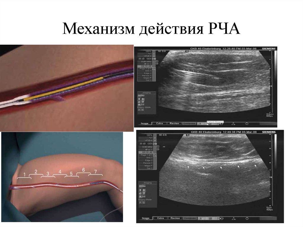 Рча сердца. Радиочастотная катетерная абляция. РЧА методика проведения. Метод радиочастотной абляции.