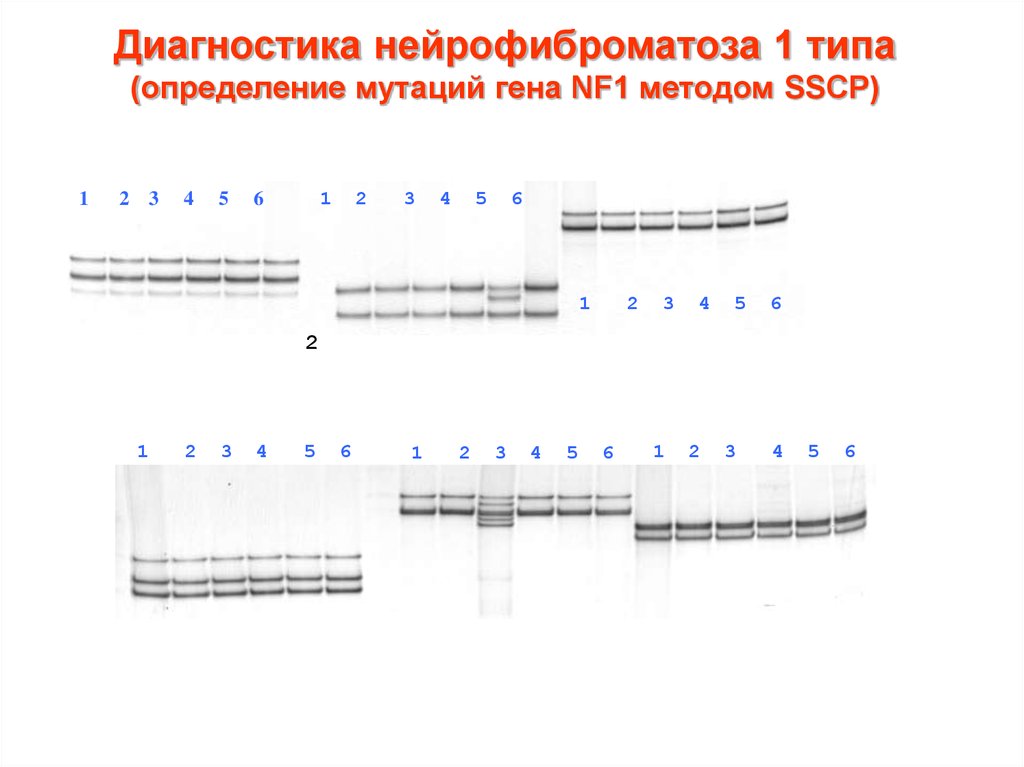 Ген nf1 расшифровка. Ген nf1 функции. Делеции в гене nf1. Гены внутри Гена nf1.