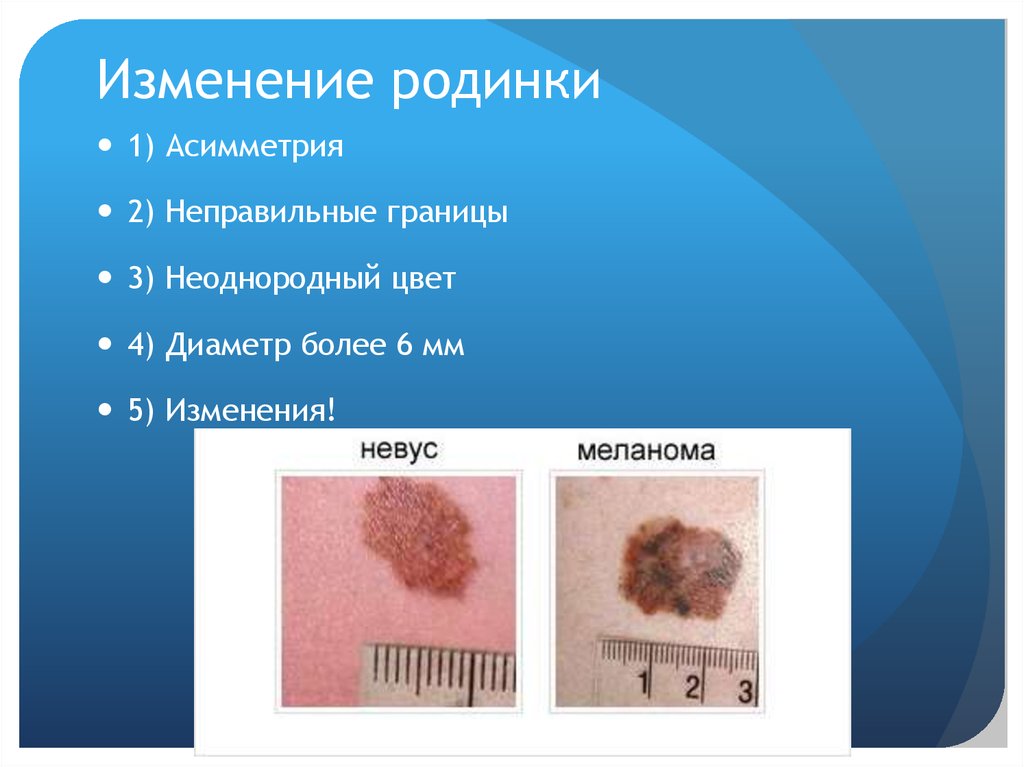 Изменение родинки