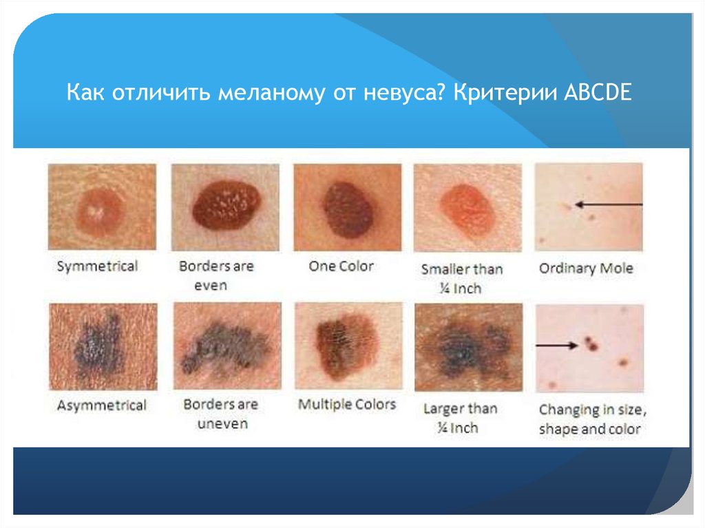 Testimonios enfermos melanoma