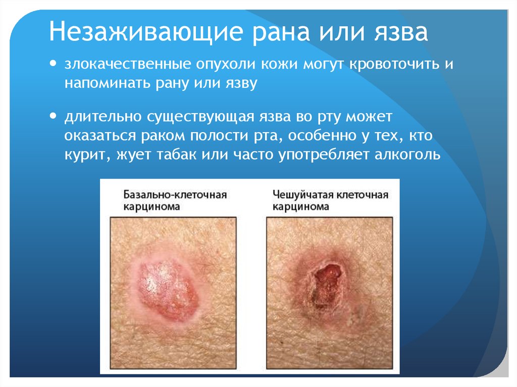 Незаживающие рана или язва