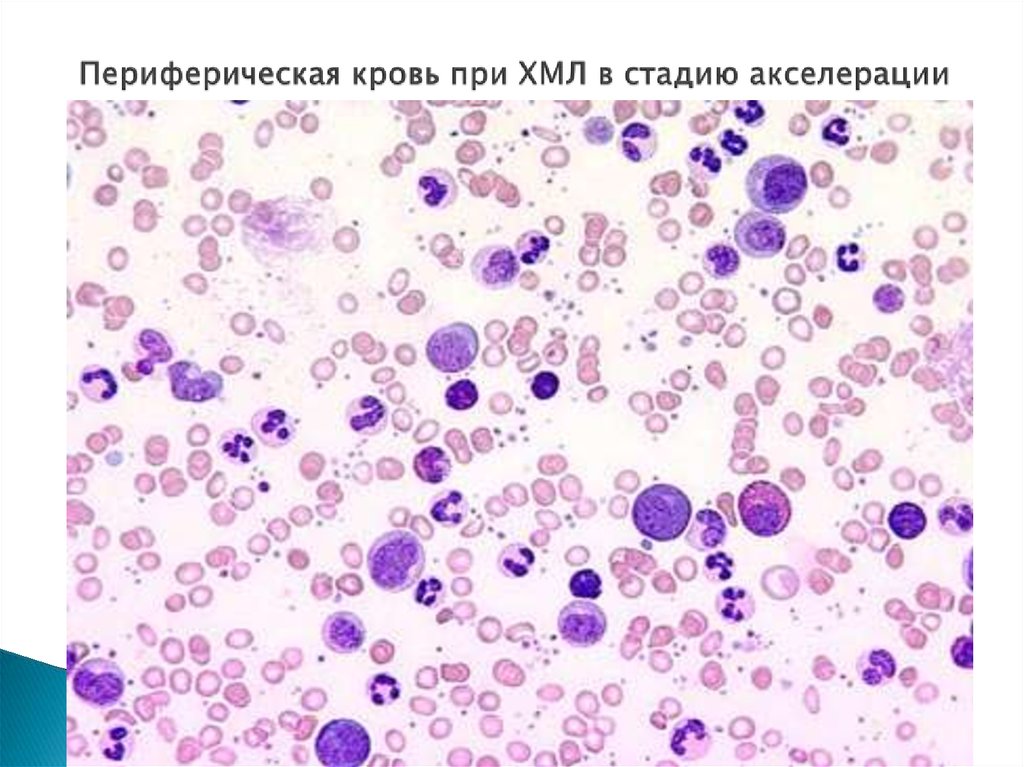 Картина крови и костного мозга при хроническом миелолейкозе истинной полицитемии