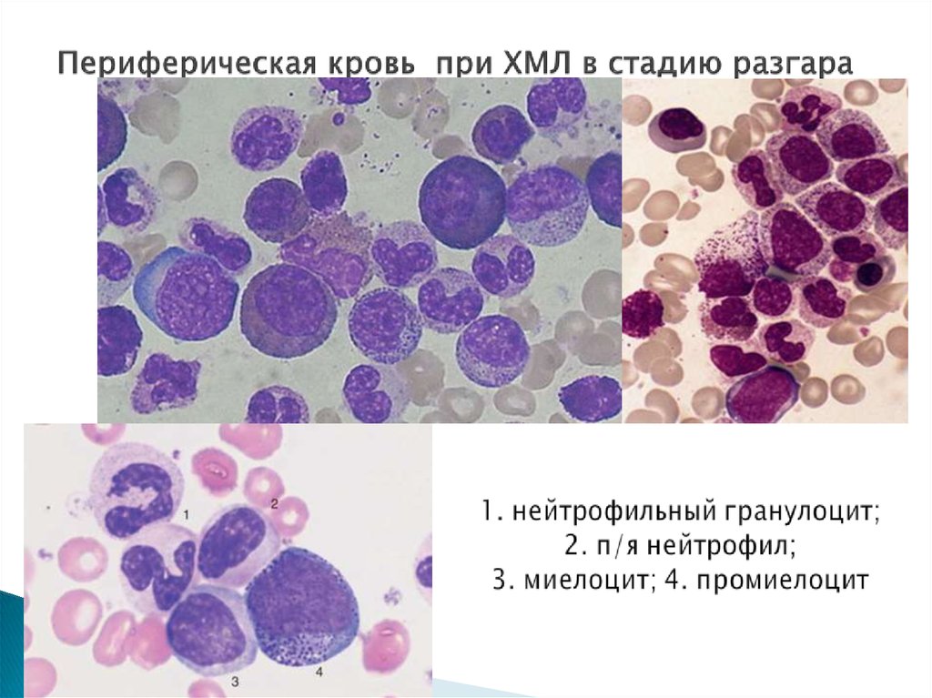 Хронический лейкоз картина крови