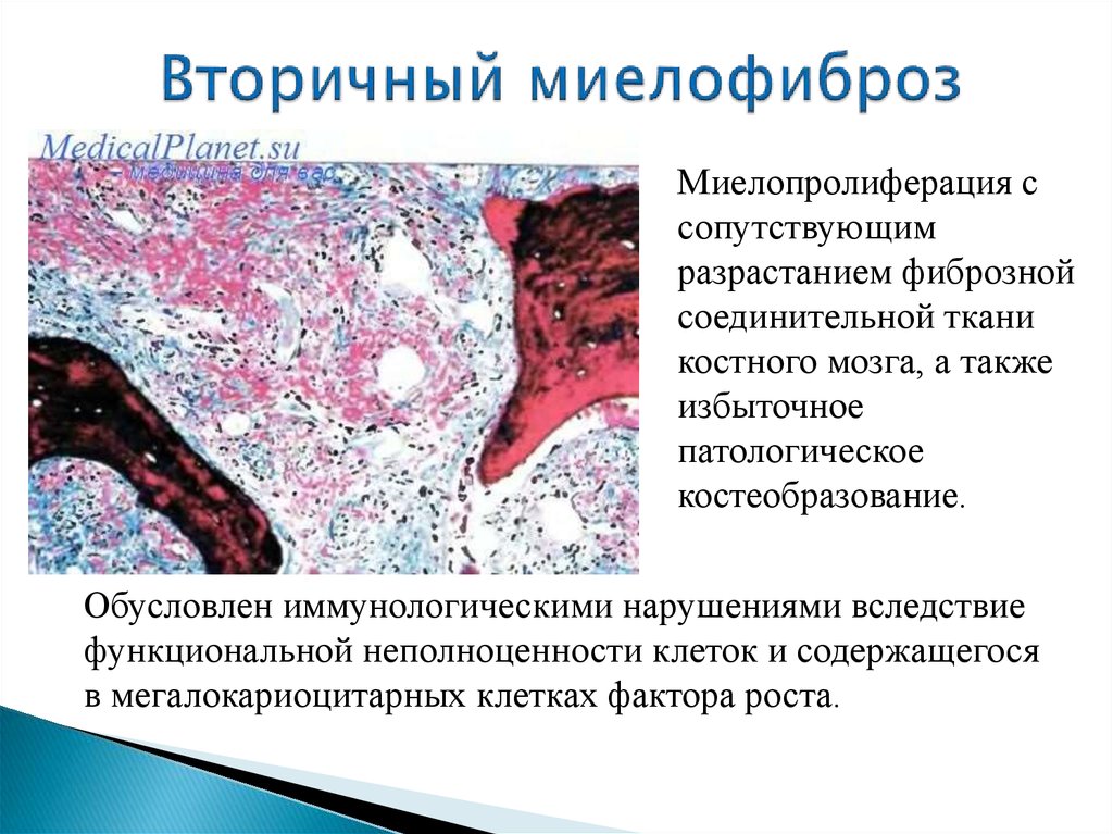 Фиброз костного мозга. Первичный миелофиброз гистология. Хронический идиопатический миелофиброз. Патанатомия. Идиопатический миелофиброз симптомы. Первичный миелофиброз этиология.