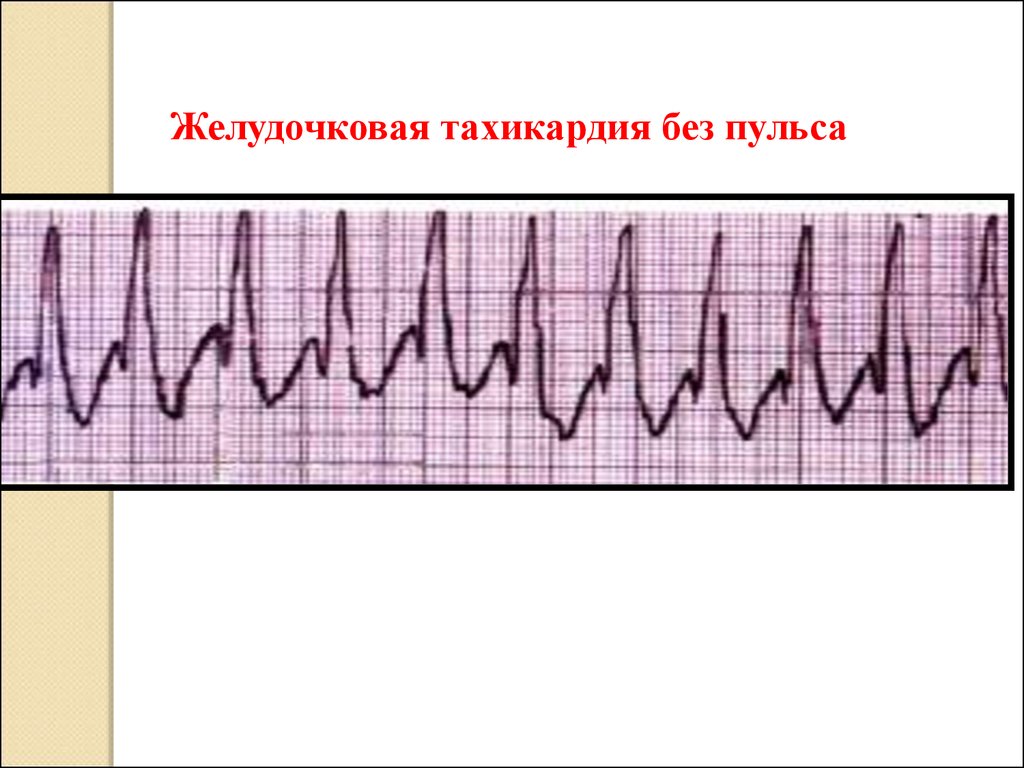 Желудочковая тахикардия. Беспульсовая желудочковая тахикардия. Фибрилляция желудочков без пульса ЭКГ. Пароксизмальная желудочковая тахикардия и трепетание желудочков. Желудочковая тахикардия без пульса на ЭКГ.