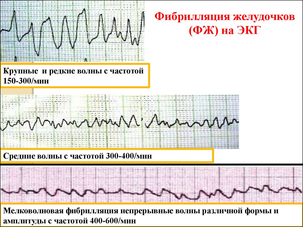 Фибрилляция на экг. Крупноволновая фибрилляция желудочков на ЭКГ. Мелковолновая фибрилляция желудочков ЭКГ. Мерцание фибрилляция желудочков ЭКГ. Трепетание и фибрилляция желудочков на ЭКГ.