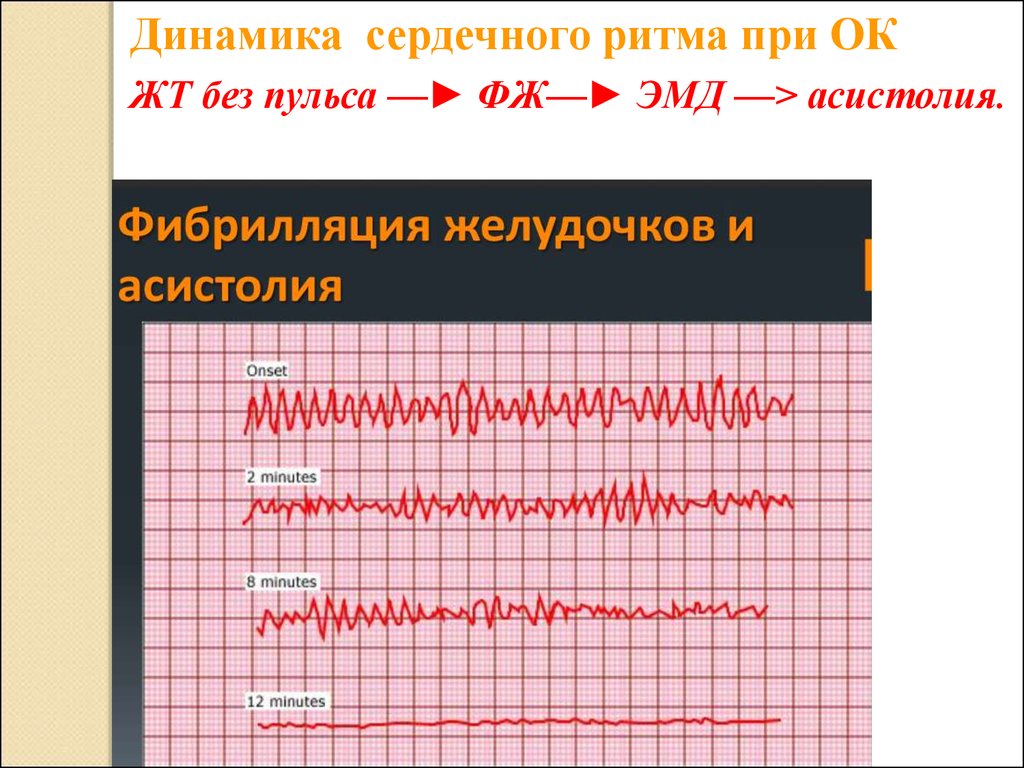 Признаки электромеханической диссоциации