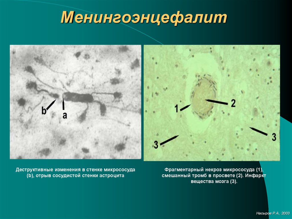 План обследования менингоэнцефалит