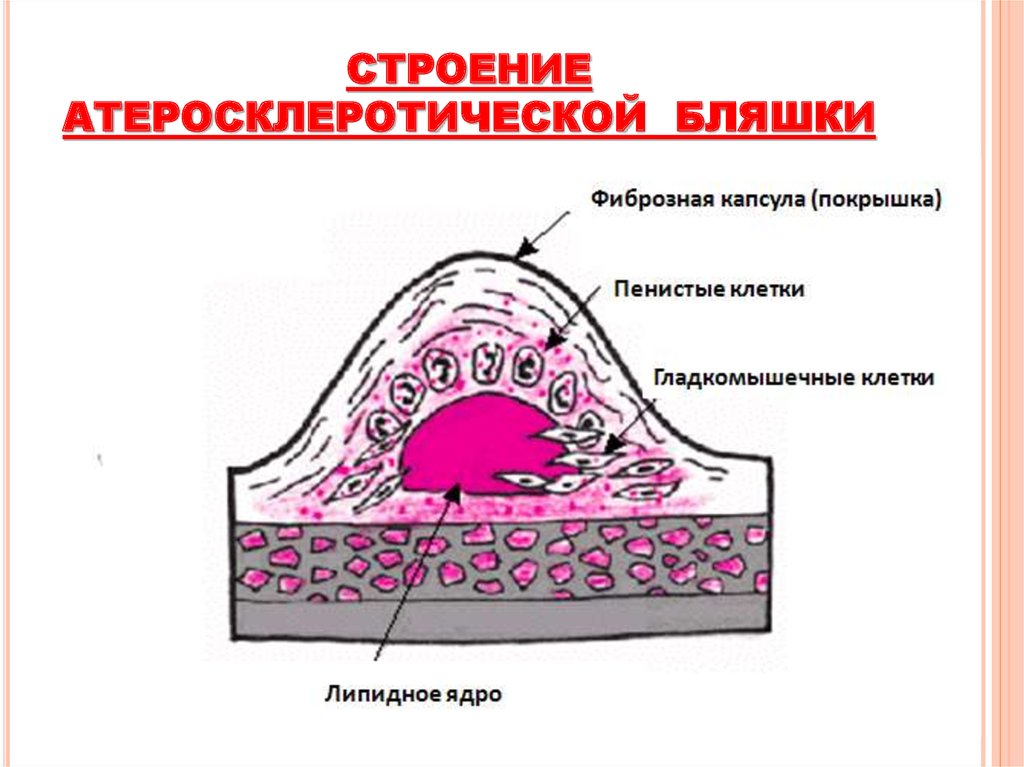 Пенистое содержимое. Атеросклеротическая и атероматозная бляшка. Фиброзная бляшка из чего состоит. Из чего состоит атеросклеротическая бляшка патанатомия. Атеросклероз строение бляшки.