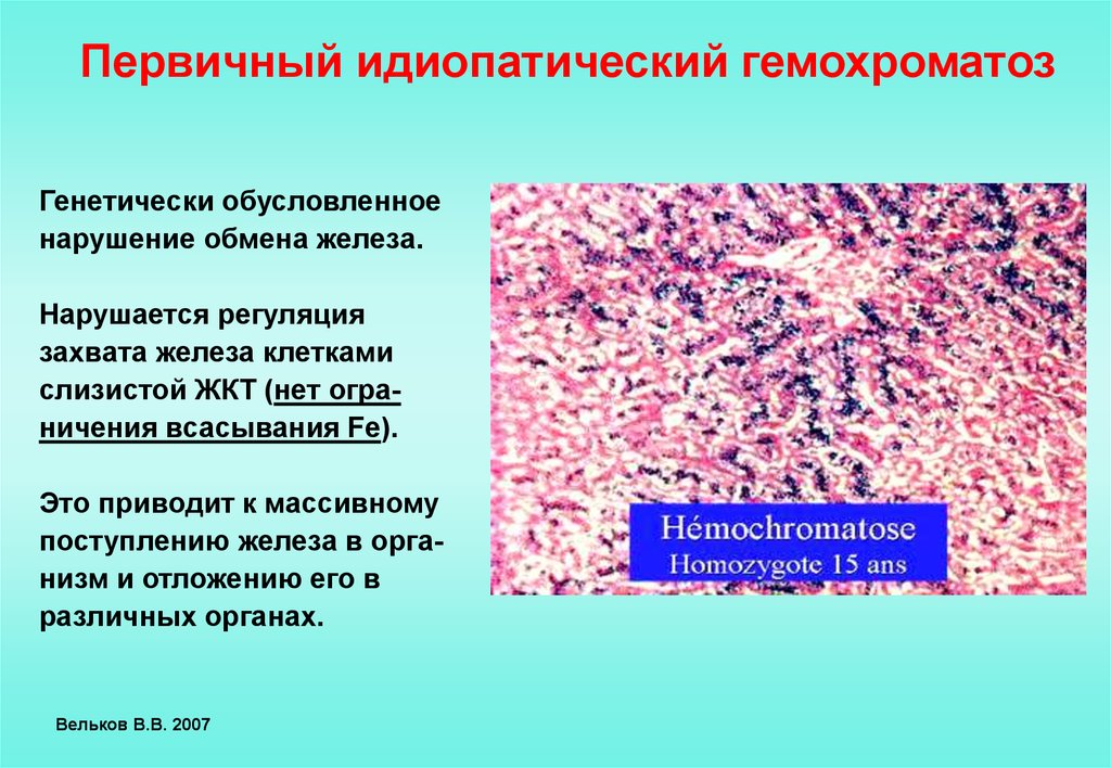 Гемохроматоз симптомы. Основной клинический признак первичного гемохроматоза:. Гемохроматоз печени патологическая анатомия. Гемохроматоз этиология патогенез. Гемосидероз и гемохроматоз.