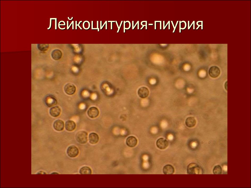 Лейкоциты в моче лейкоцитурия