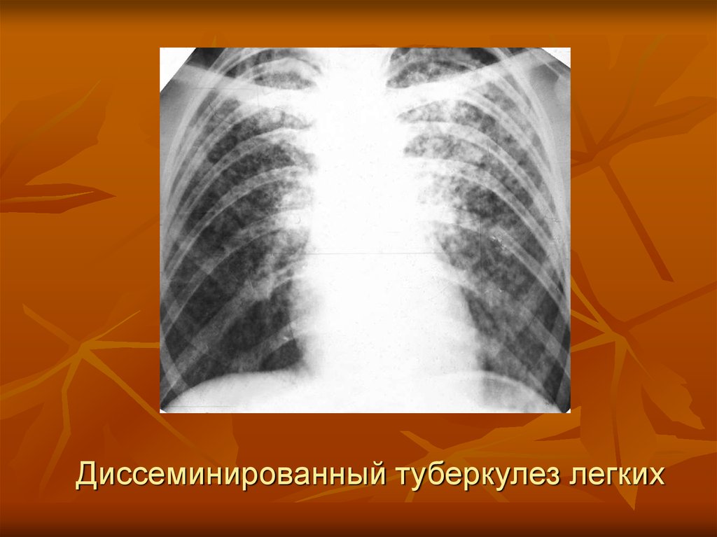 Лимфогенный туберкулез. Лимфогенно диссеминированный туберкулез рентген. Подострый диссеминированный туберкулез легких рентген. Хронический диссеминированный туберкулез рентген. Острый диссеминированный туберкулез рентген.