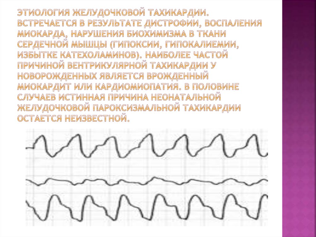 Тахикардия у ребенка. Врожденная тахикардия. Тахикардия у новорожденных. Тахикардия у новорожденного ребенка. Причины тахикардии у детей.