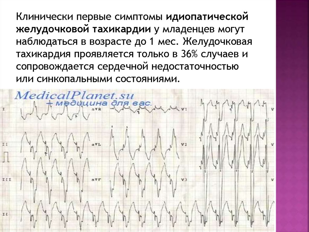 Тахикардия у ребенка. Синусовая тахикардия у новорожденного. Причины синусовой тахикардии у новорожденных. Идиопатическая желудочковая тахикардия. Идиопатическая пароксизмальная тахикардия.