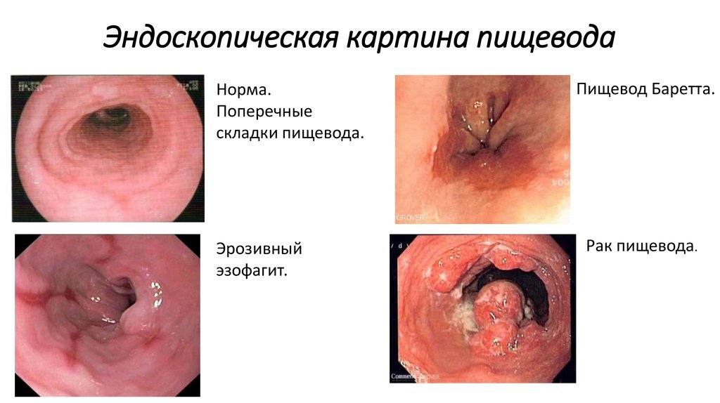 Эндоскопическая картина пищевода
