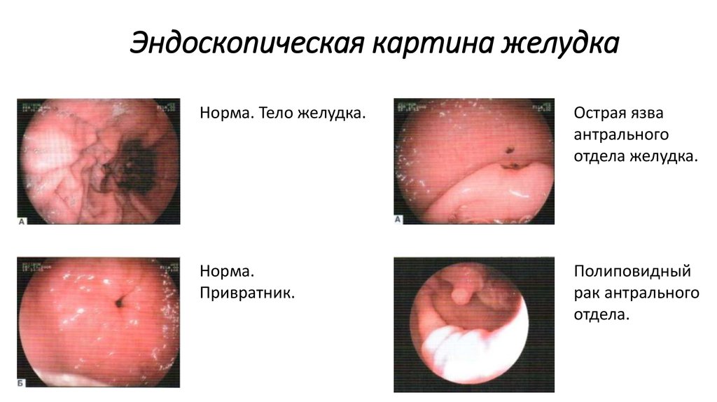 Эндоскопическая картина желудка
