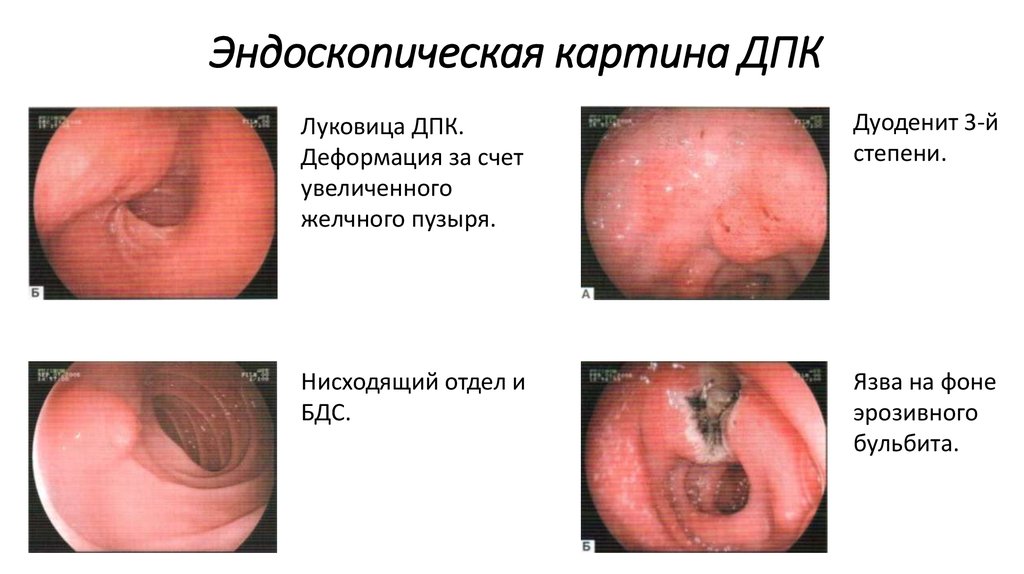 Эндоскопическая картина ДПК