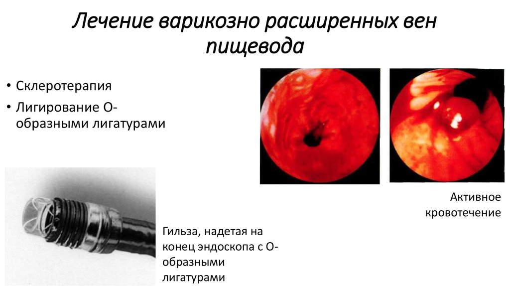 Лечение варикозно расширенных вен пищевода