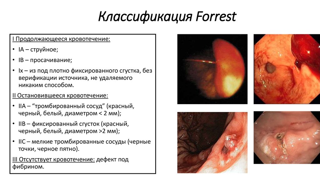 Классификация Forrest