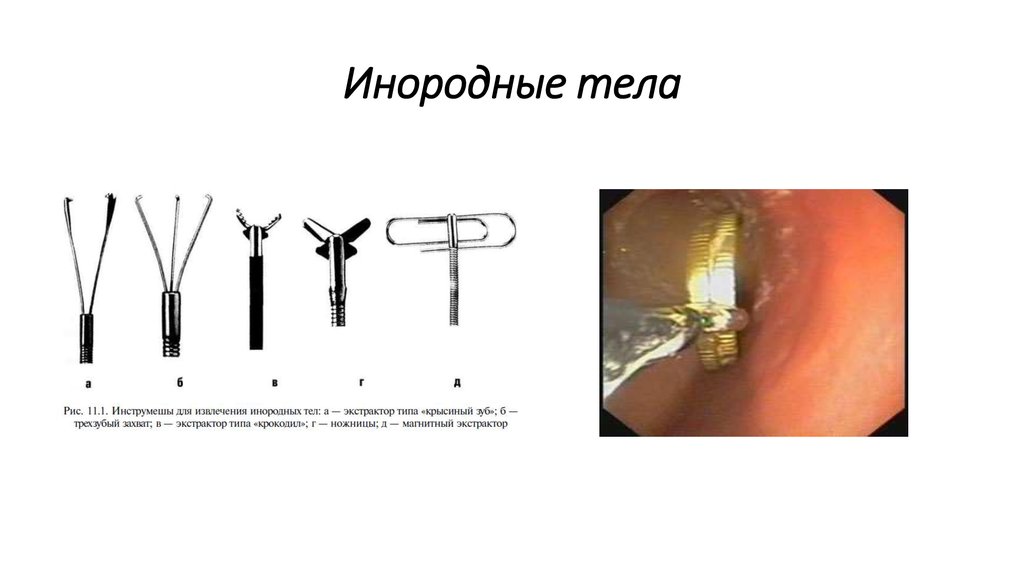 Инородные тела презентация