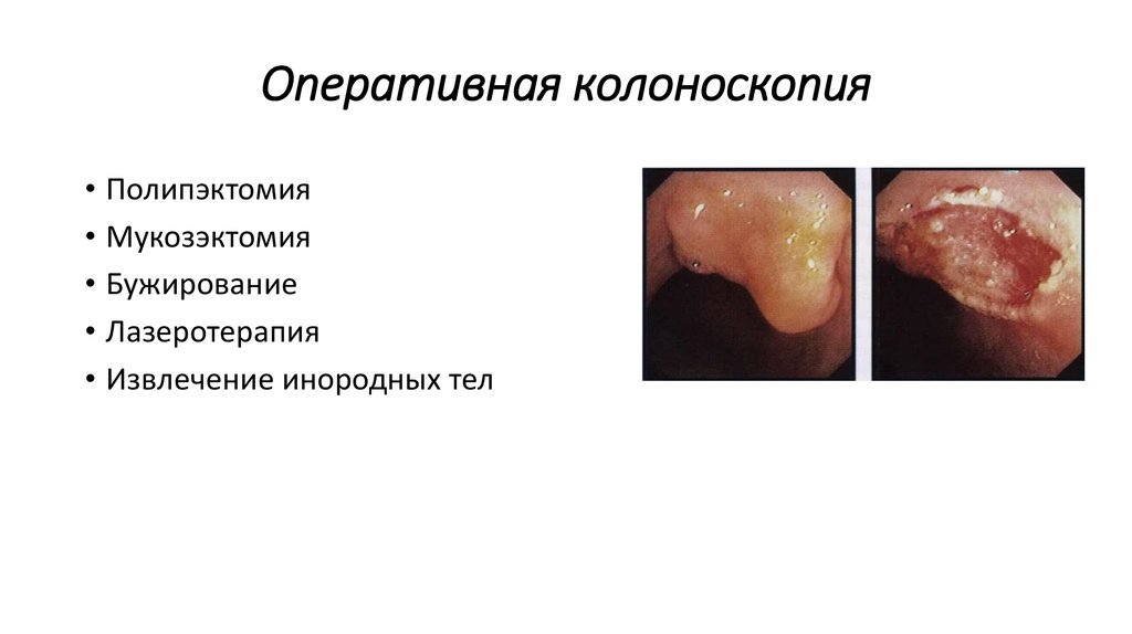 Оперативная колоноскопия
