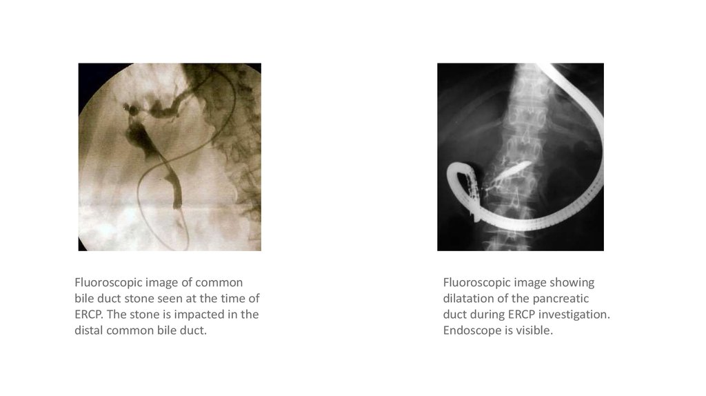 Эндоскопическая папиллосфинктеротомия презентация
