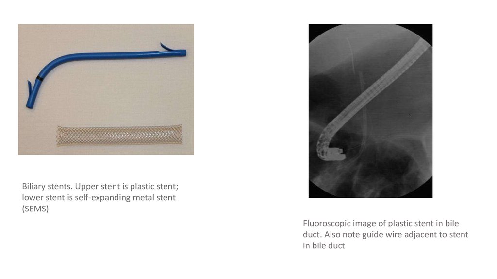Also of note. Рассасывающийся стент. Стент пищеводный рассасывающийся Ella. Стент Даниша и зонд Блэкмора отличия. Stent Geometry разновидности по способу соединения распорок.
