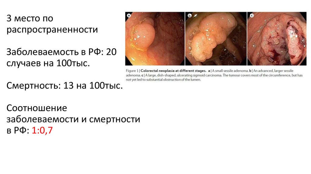 3 место по распространенности Заболеваемость в РФ: 20 случаев на 100тыс. Смертность: 13 на 100тыс. Соотношение заболеваемости и
