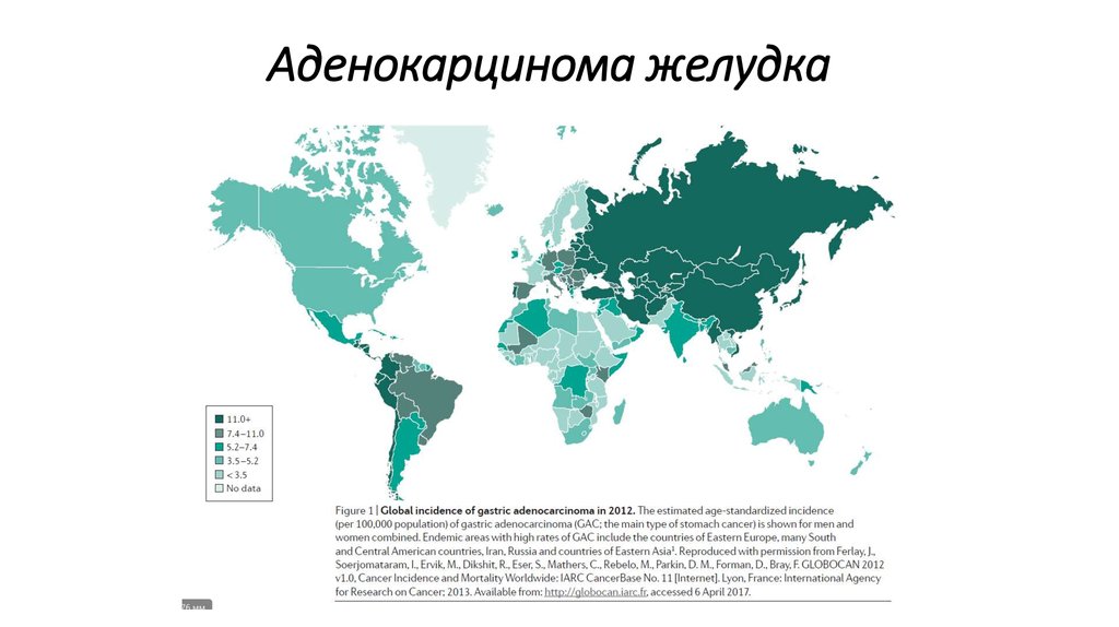 Аденокарцинома желудка
