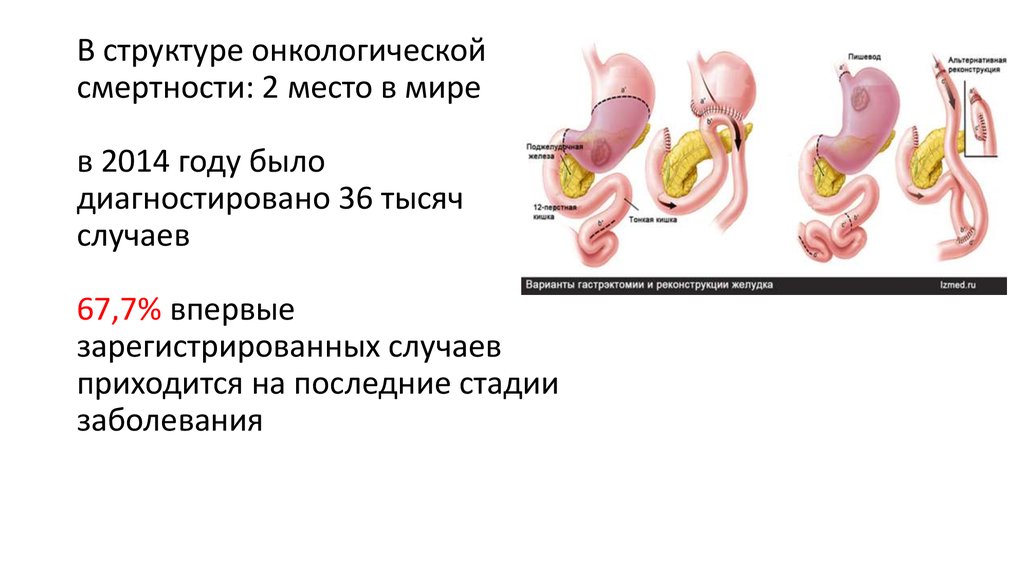 В структуре онкологической смертности: 2 место в мире в 2014 году было диагностировано 36 тысяч случаев 67,7% впервые